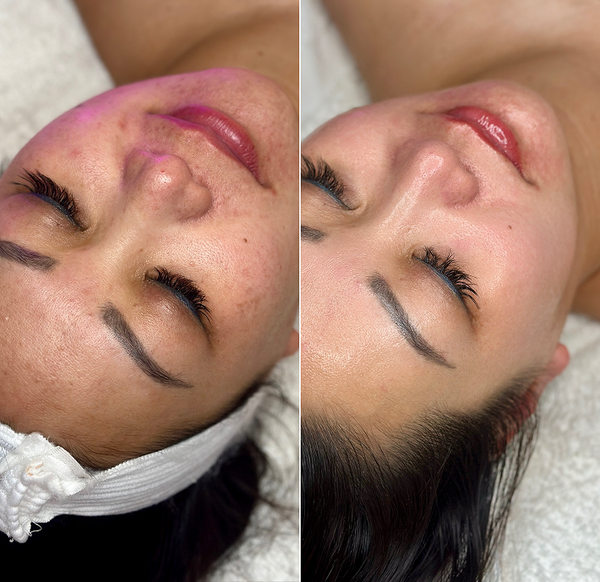 Treatment result