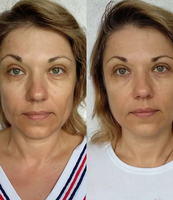 Treatment result